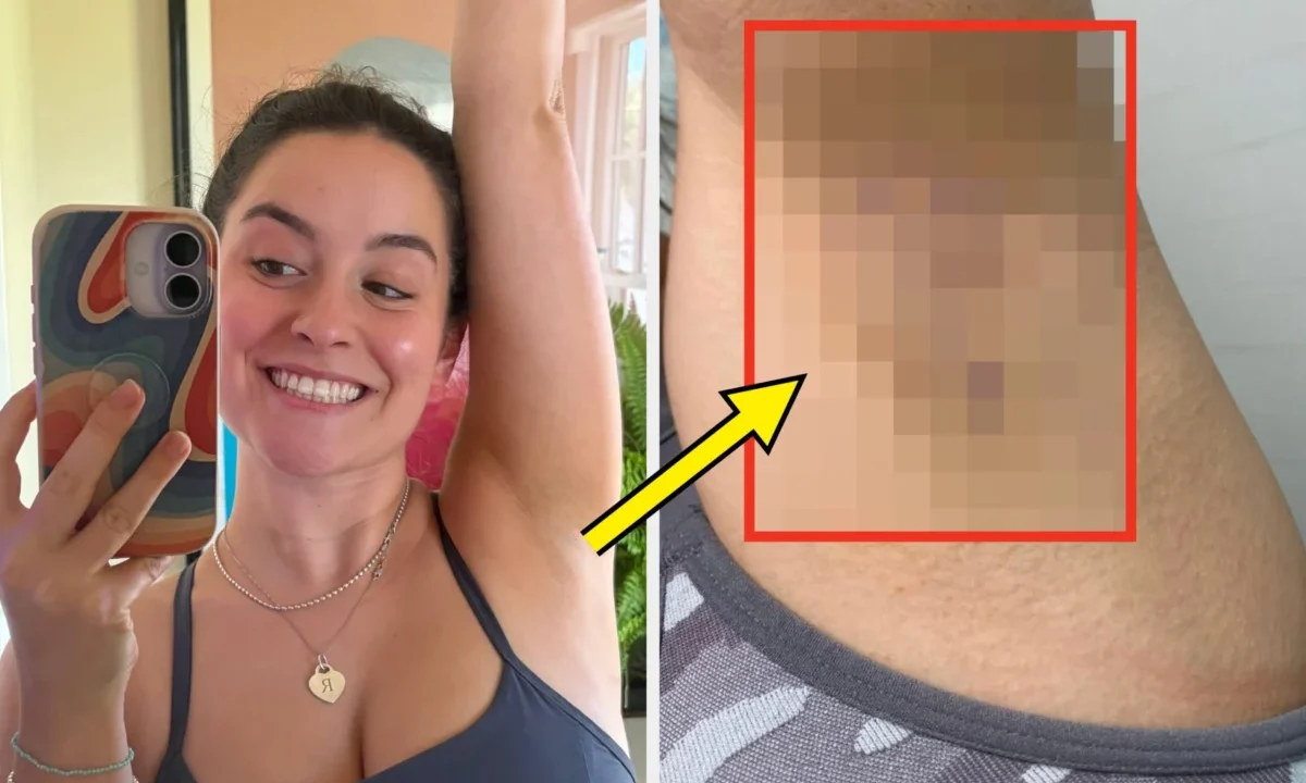 Beyond the Surface: How One Woman’s Quest to Conquer Armpit Hyperpigmentation Led Her to Laser Hair Removal